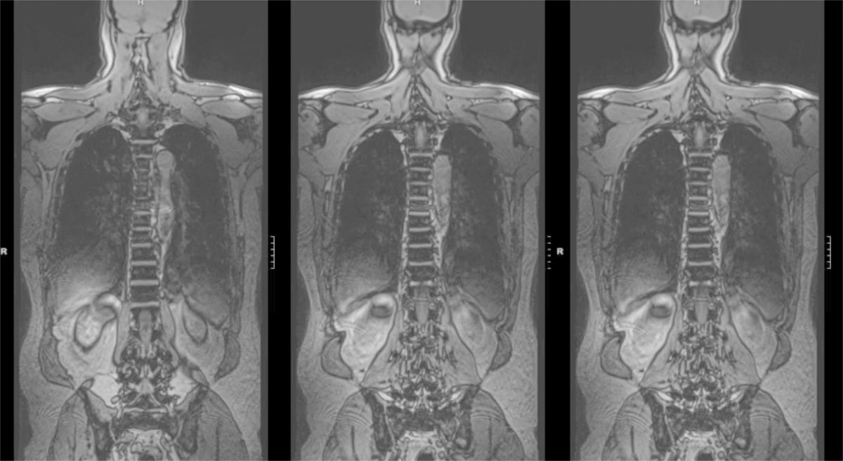 MRI Images