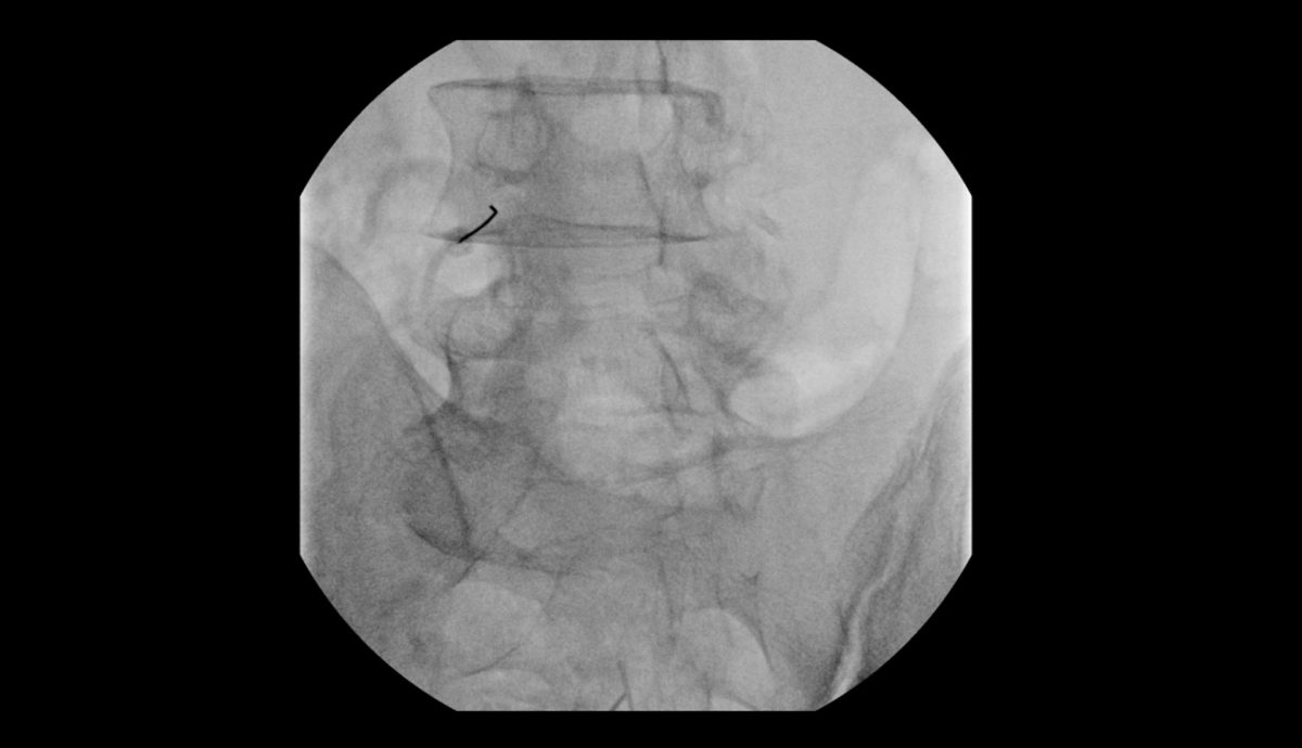 spine pain