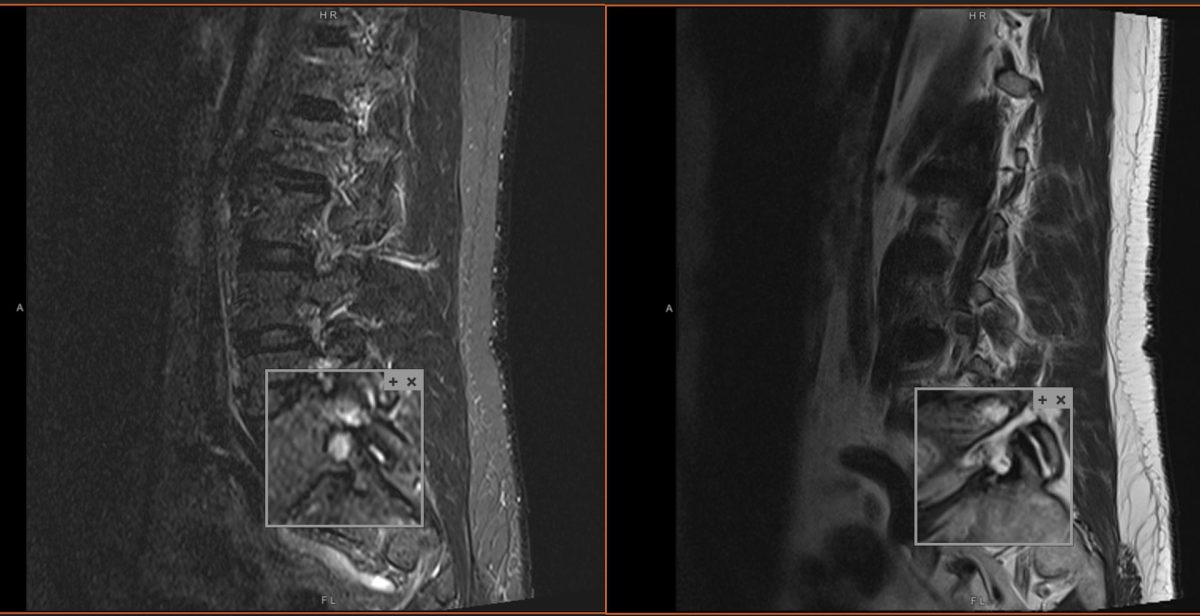 MRI