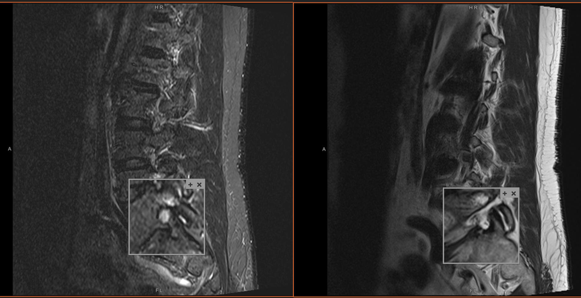 MRI